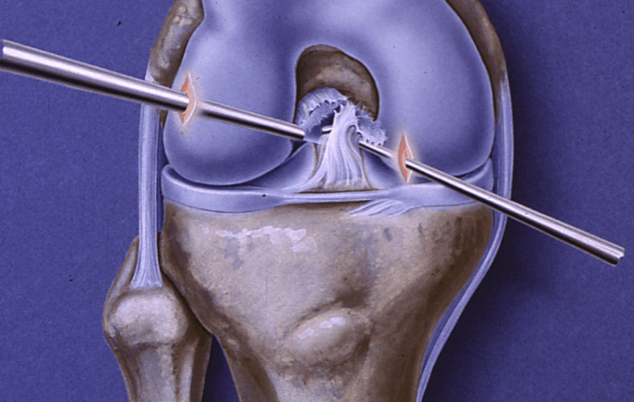 Broken Collarbone Surgery Rehab Protocol And Recovery Time